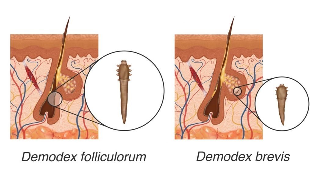 01-what-are-demodex-mites-and-what-role-do-they-play-in-acne.jpg.7aa8a397698678807a75d55b19b55146-1024x631-1