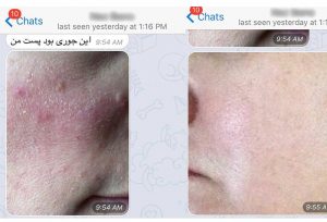 1-ungex-review-testimonial-demodex-treatment | Ungex