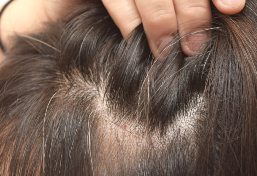 Hair Thinning and Demodex Mites | Ungex | Demodex Treatment