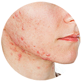 acne1 | Ungex | Demodex