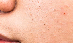 blackhead_face-large | Ungex | Demodex