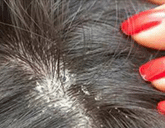 dandruff | Ungex
