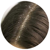 dandruff1 | Ungex | Demodex