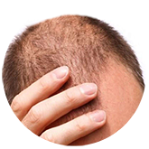 hair-loss1 | Ungex | Demodex