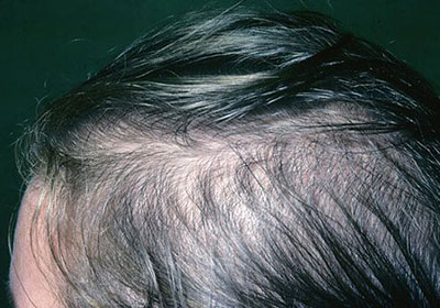 Hair Thinning and Demodex Mites | Ungex | Demodex Treatment Hair Thinning and Demodex Mites | Ungex | Demodex Treatment
