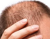 hairloss | Ungex