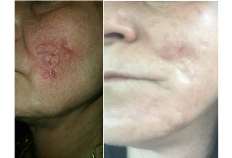 Help Treat Demodex Mites Hair loss, Acne Ungex Products