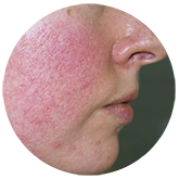 rosacea1 | Ungex | Demodex