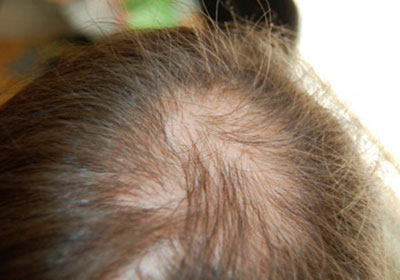 Hair Loss and Demodex Mites | Ungex | Demodex Treatment