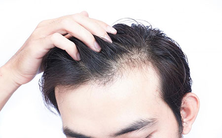 Hair Loss and Demodex Mites | Ungex | Demodex Treatment
