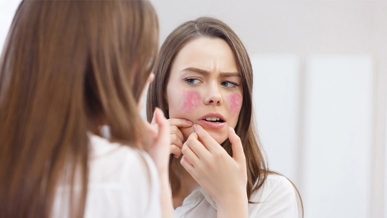 Causes of Rosacea | Ungex