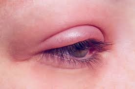 Sore or greasy eyelids | Ungex