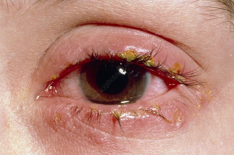 Blepharitis-inflammation of eyelids | Ungex