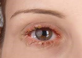 Symptoms of Blepharitis1 | Ungex