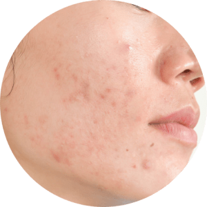 Demodex Mite and Acne Face | Ungex Circle