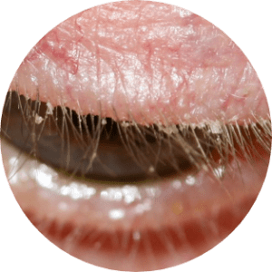 blepharitis-circled-ungex