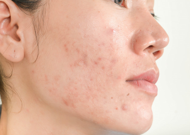 Demodex Mite and Acne Face | Ungex
