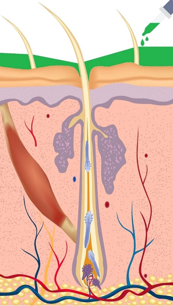 infected hair follicle | Ungex