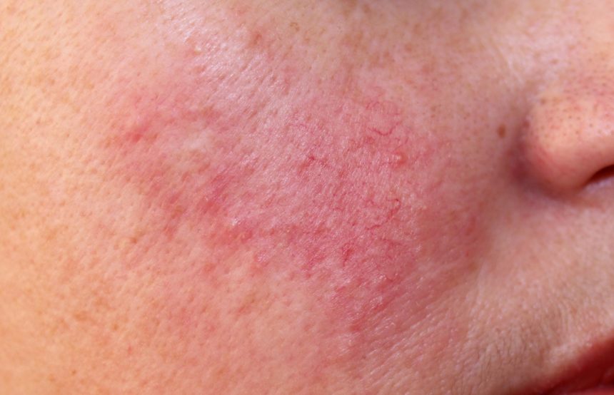 rosacea type ungex