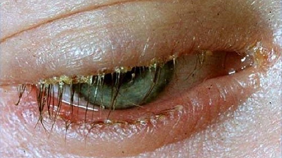 Eyelash mite | Ungex
