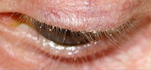 blepharitis demodex mites