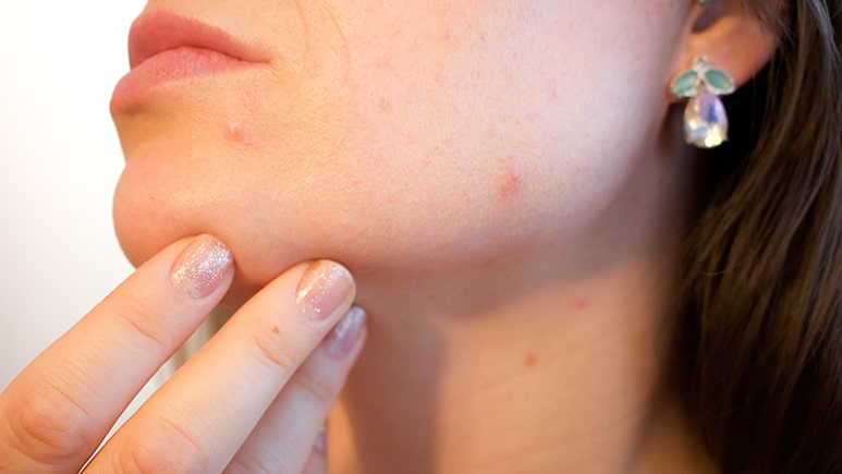 How Long Does It Take to Get Rid of Demodex Mites