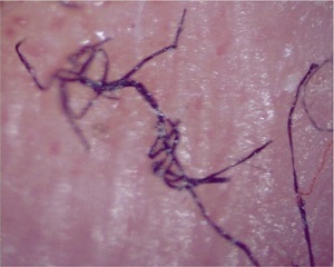 Morgellons | Ungex