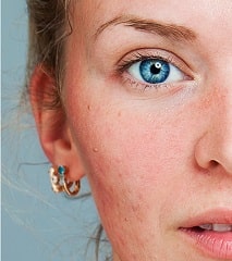 Rosacea | Ungex
