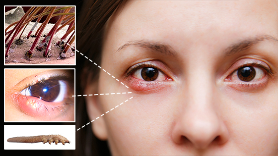 eyelash mites | Ungex