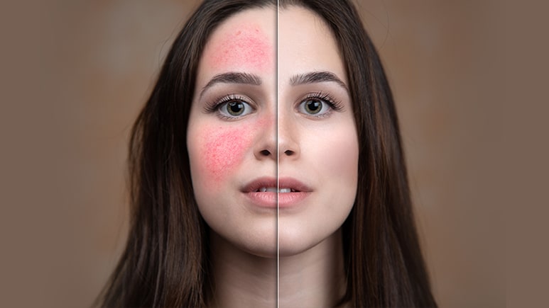 Causes of Rosacea | Ungex