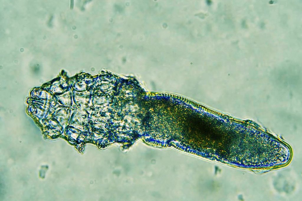 Demodex Mites on Children