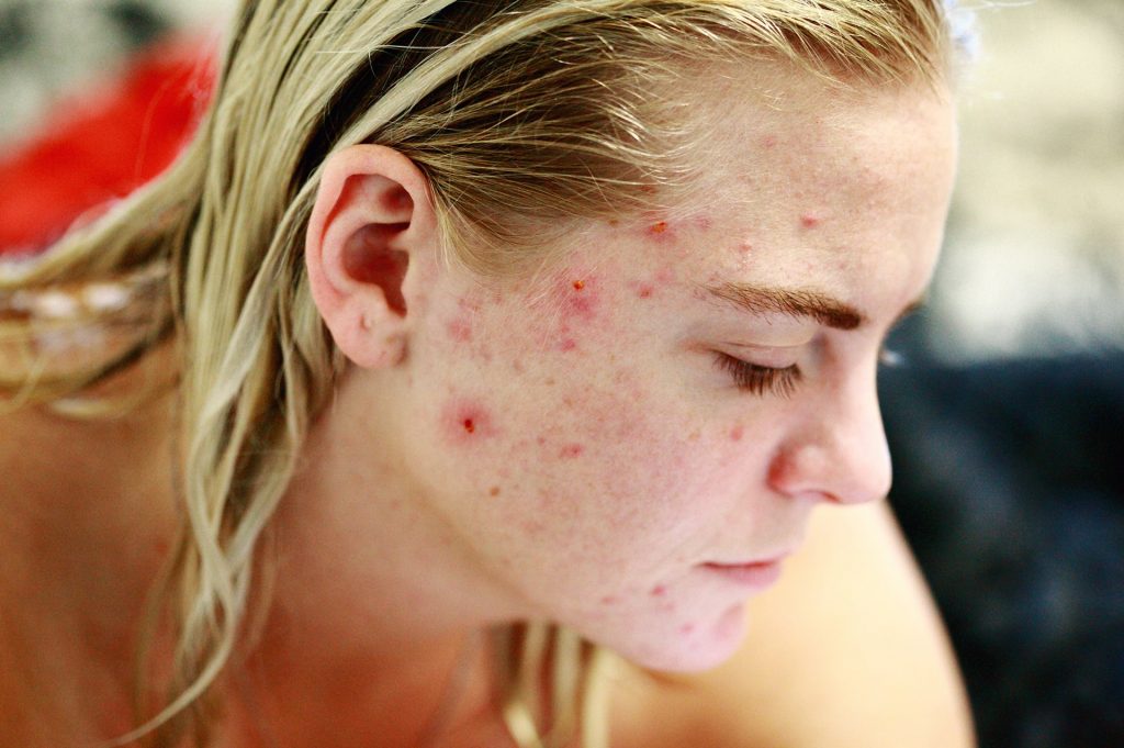 How to Know If You Have Demodex Mites? | Ungex How to Know If You Have Demodex Mites? | Ungex