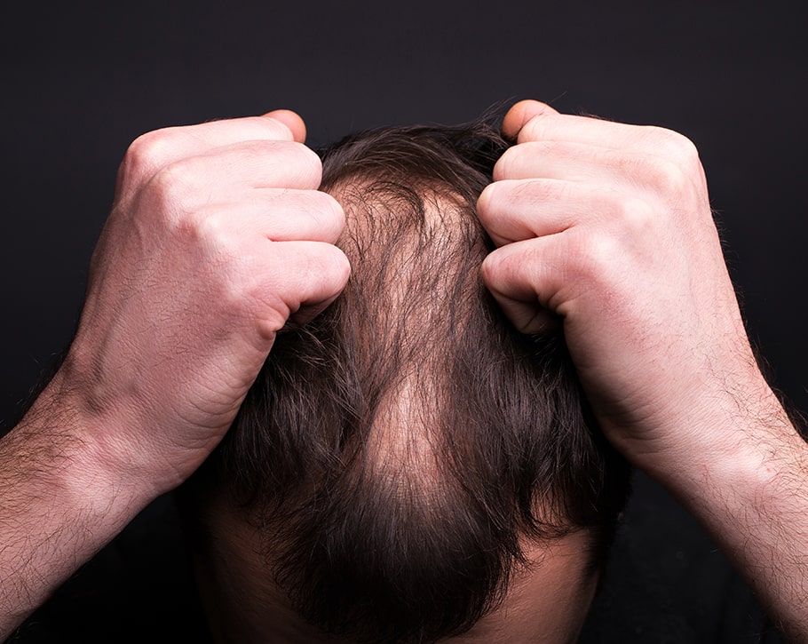 Hair Loss and Demodex Mites | Ungex | Demodex Treatment Hair Loss and Demodex Mites | Ungex | Demodex Treatment