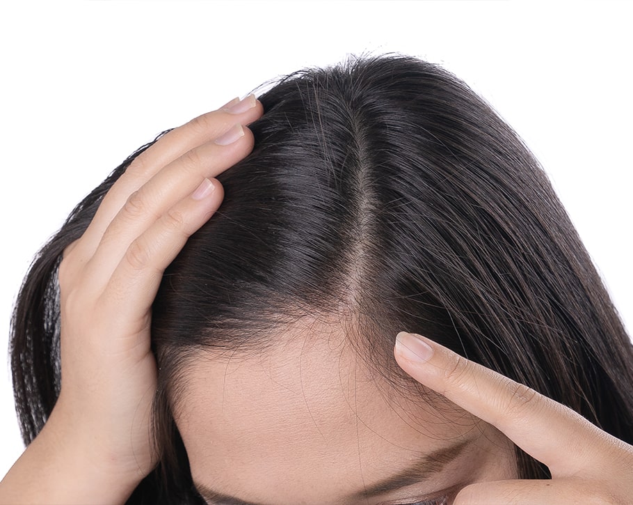 Hair Loss