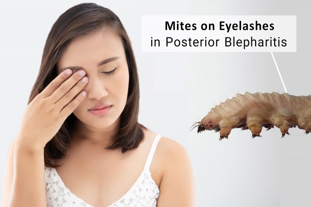 Mites-on-Eyelashes-in-Posterior-Blepharitis