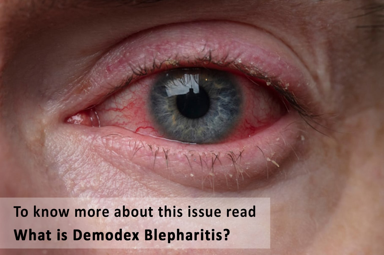 Ungex | What is Demodex Blepharitis