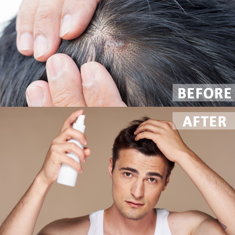More About Mites | Ungex Human Hair Mite Demodex Treatment More About Mites | Ungex Human Hair Mite Demodex Treatment