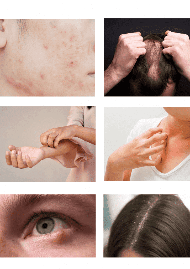 More About Mites | Ungex Human Hair Mite Demodex Treatment