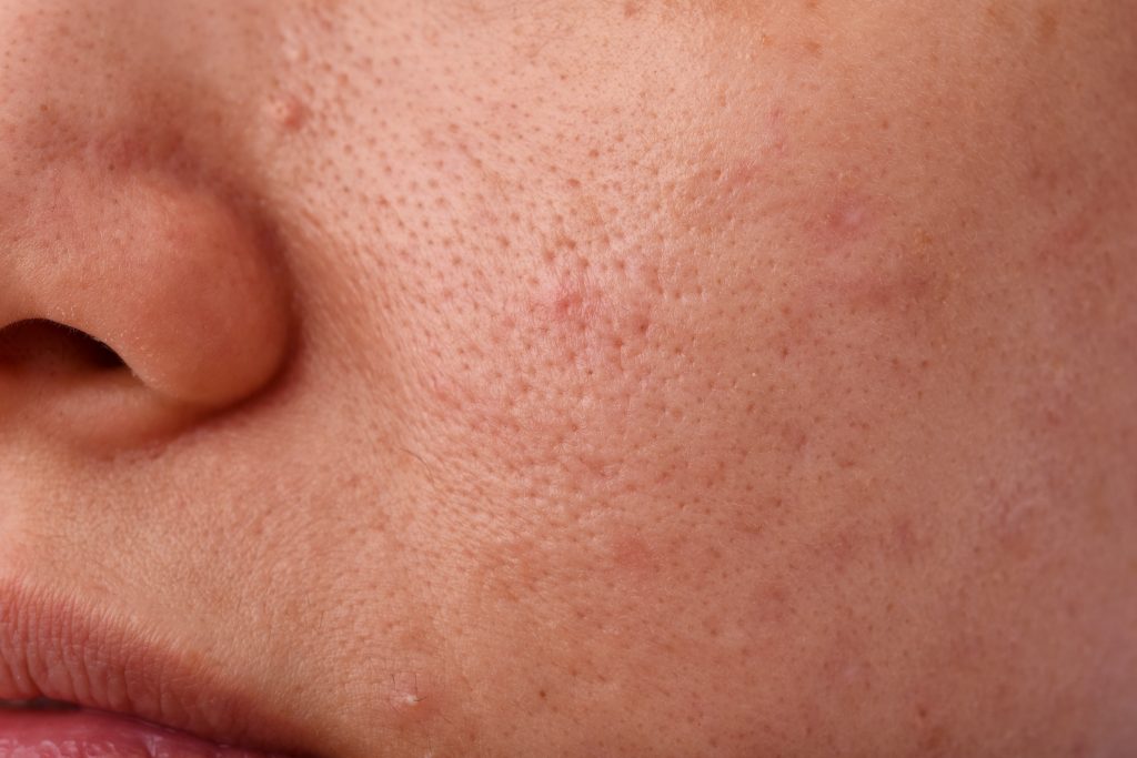 Closing Pores Cause Acne