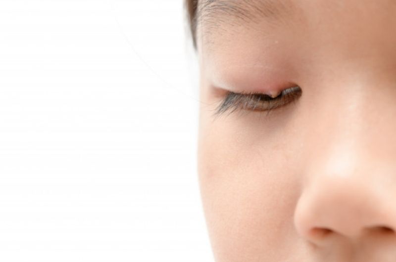 Chalazion