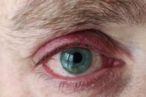 Blepharitis and Demodex mites - Ungex | Demodex treatment