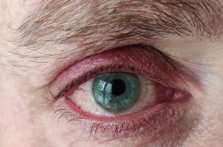 Blepharitis and Demodex mites Ungex Demodex treatment