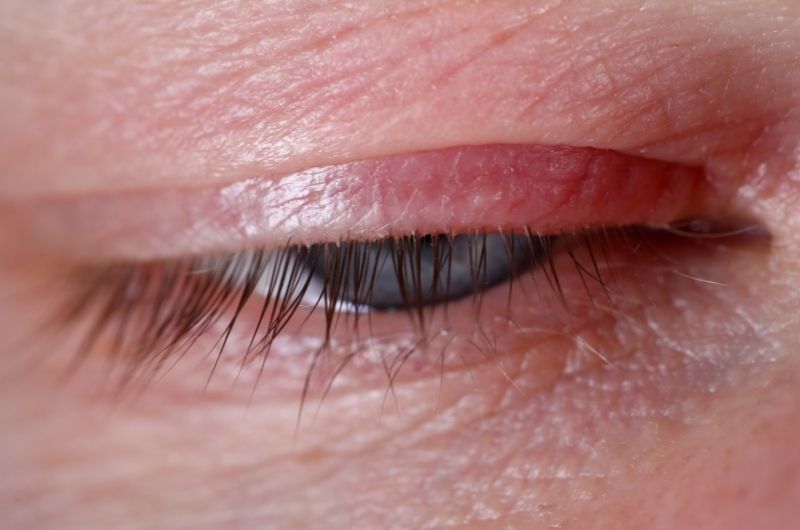 redness and demodex