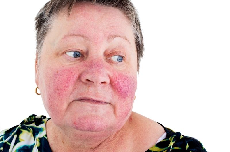 rosacea