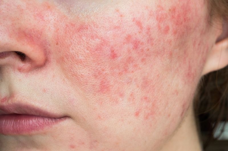 skin redness