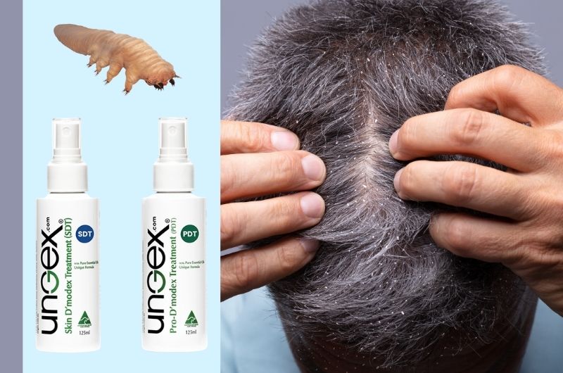 Does Dandruff Cause Hair Loss? Dandruff and Hair Loss Linkage - Ungex