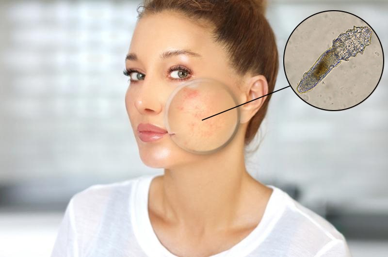 demodex mite infestation