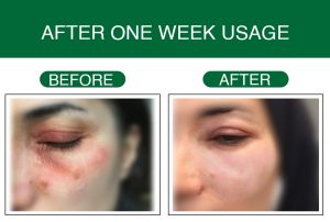 Testimonial | Blepharitis