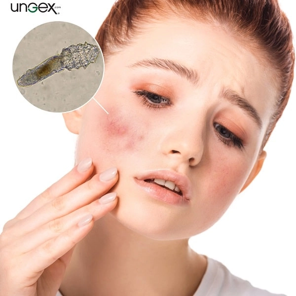 Demodex acne | Ungex