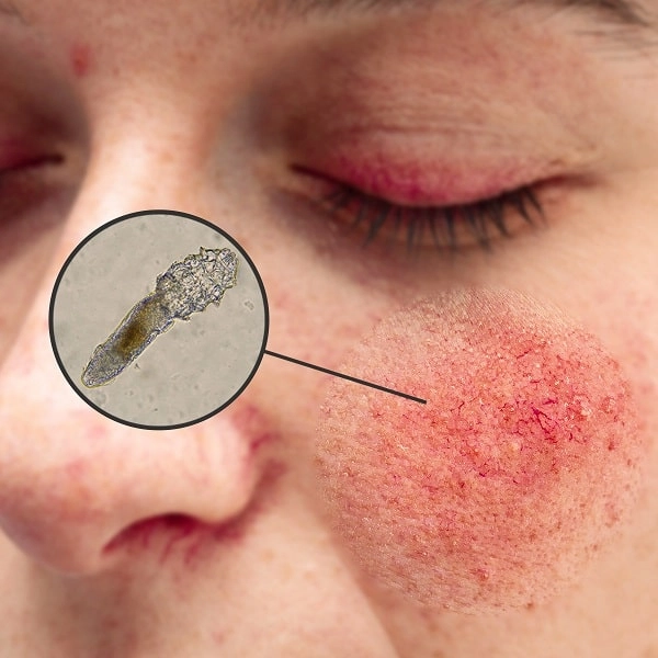 Demodex rosacea | Ungex